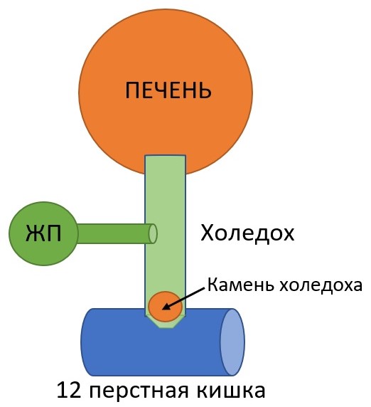 Холедохолитиаз