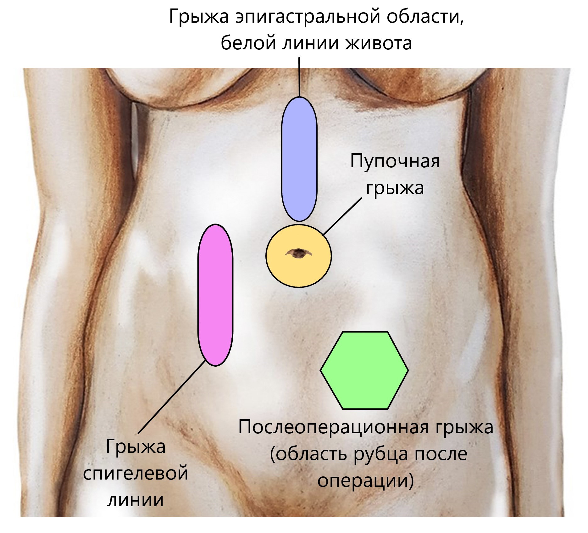 грыжи на грудях у мужчин фото 83